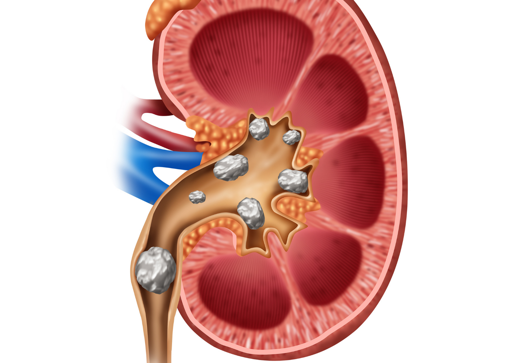 RA Bilateral Pelviureteric Junction Obstruction with kidney stones