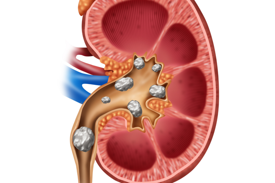 Kidney Stones | Urologic Conditions | Urology