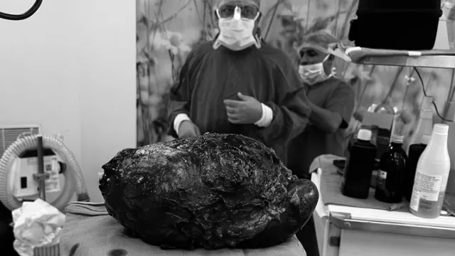 Doctors in Delhi saved a young man’s life by surgically removing a 24-centimeter, 2.5-kilogram tumor from his adrenal gland.
