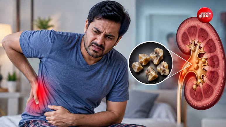बार-बार किडनी में पथरी क्यों बनती है? कहीं किसी दूसरी बीमारी की वजह तो नहीं?